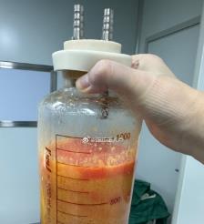 四川水动力吸脂手术要做多久？